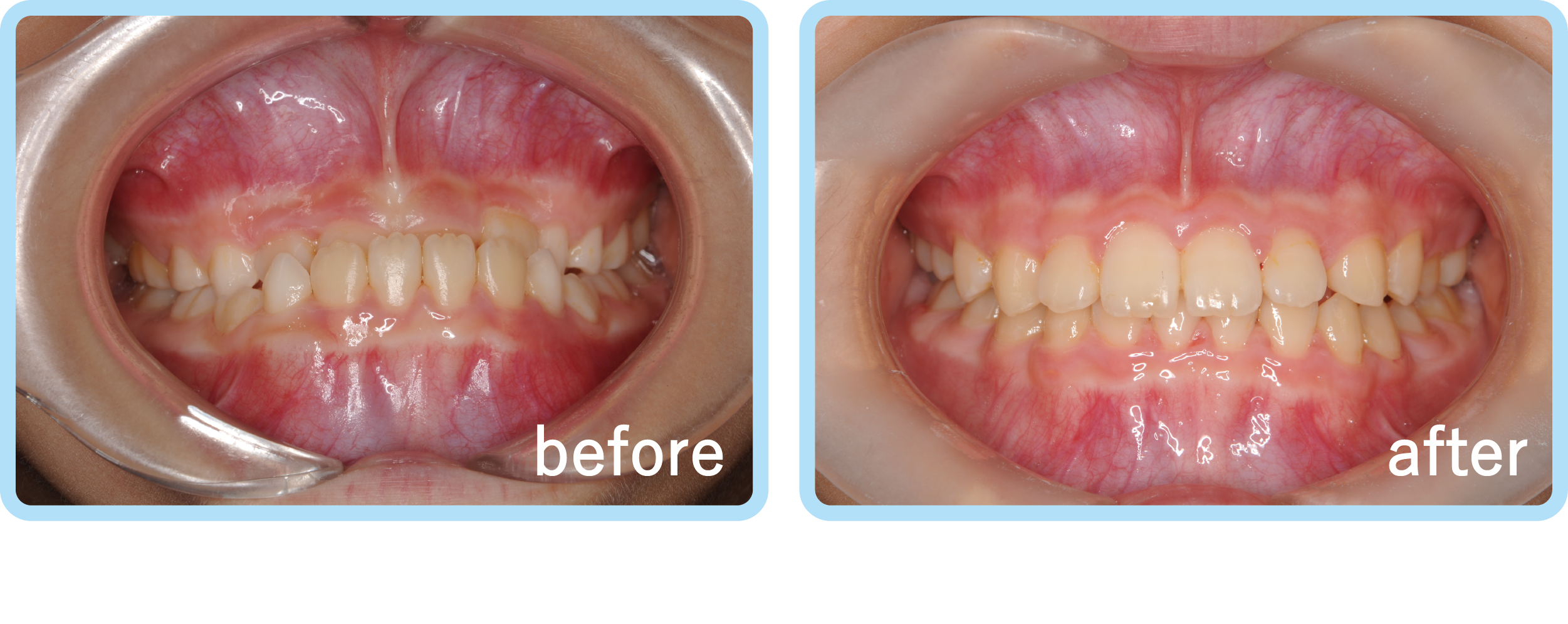 重度の受け口 近医からのご紹介 こどもの矯正 こどもから大人まで通える矯正歯科 白数デンタルオフィス