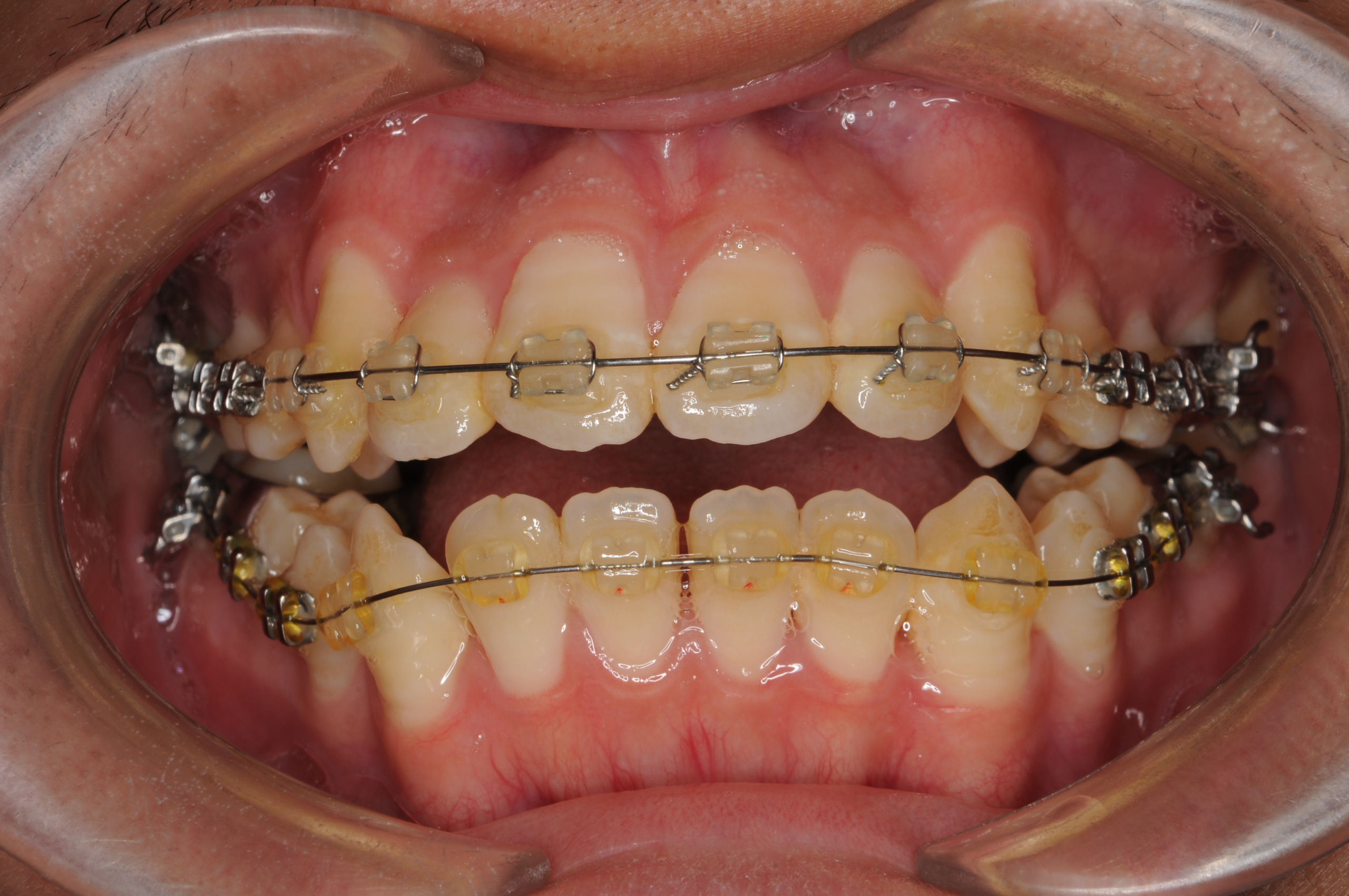 開咬を外科手術なしでなおしたい。10代男性。セカンドオピニオン « 白